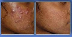 Acne Before After